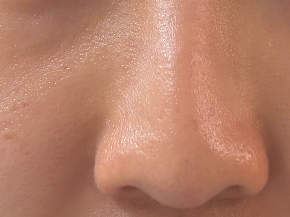 Close up of clean and clear pores on nose and cheeks after double cleansing with Manyo Pure Cleansing Oil.